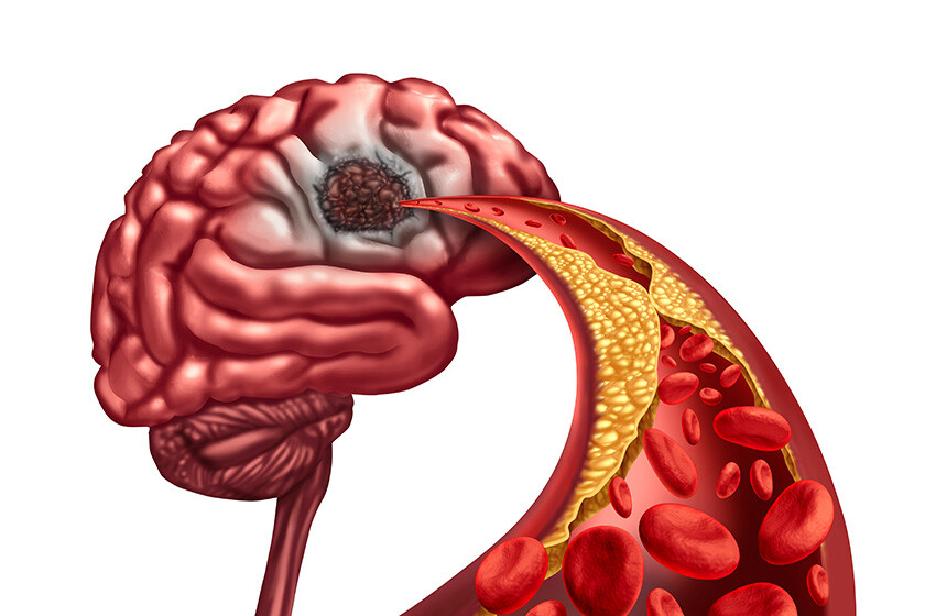 Vascular Dementia and Brain Liquefactive Necrosis due to loss of blood circulation to the mind after a stroke caused by artery blockage resulting in dead tissue damage and mental function with 3D render elements